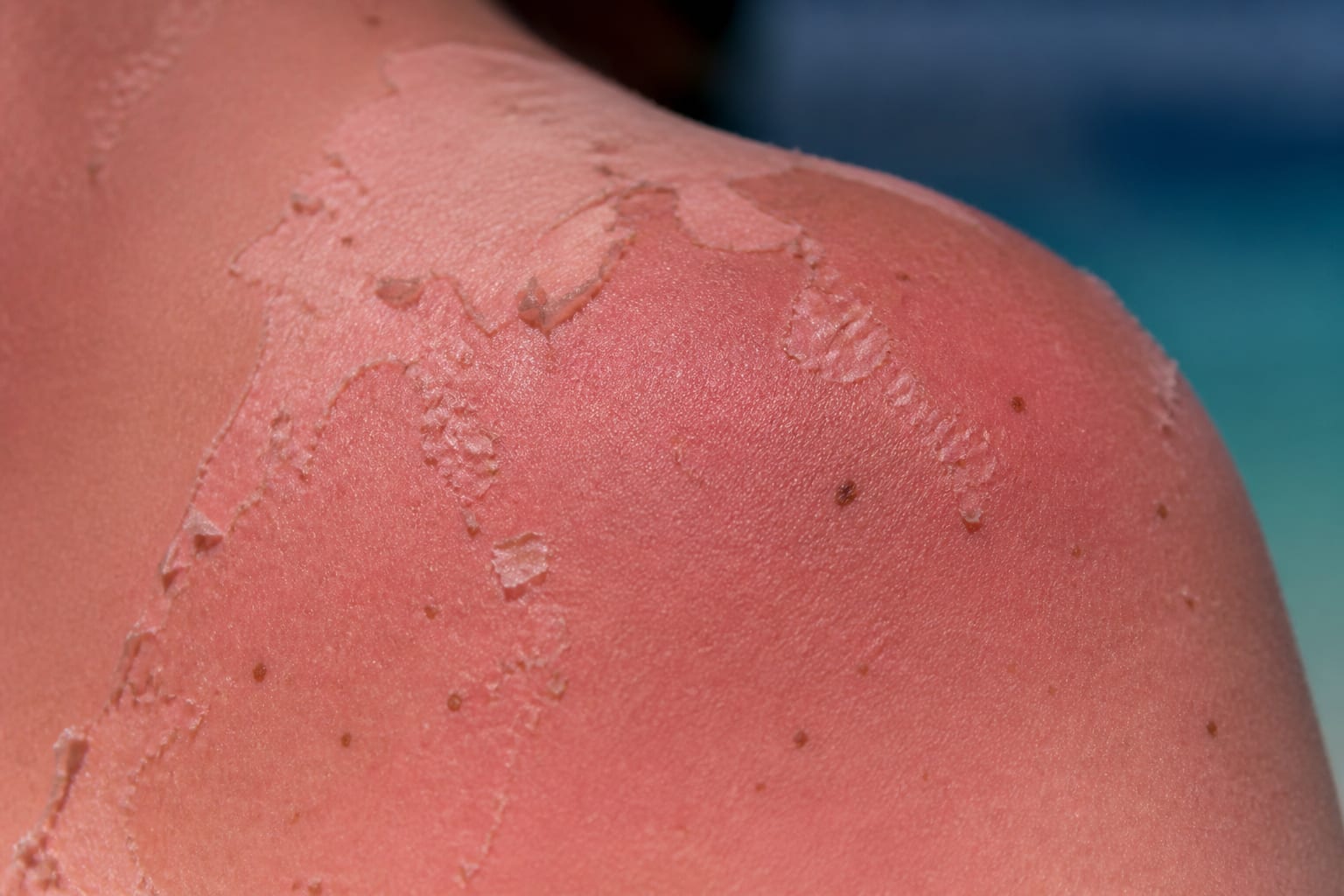 Cinci arsuri solare pot dubla riscul de melanom, avertizează medicii